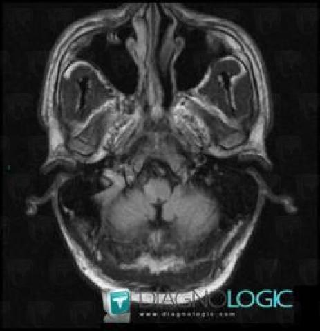 Cerebral infarction, Brainstem, Posterior fossa, MRI