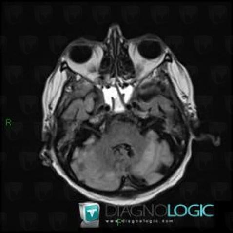 Cerebral infarction, Cerebellar hemisphere, Posterior fossa, MRI