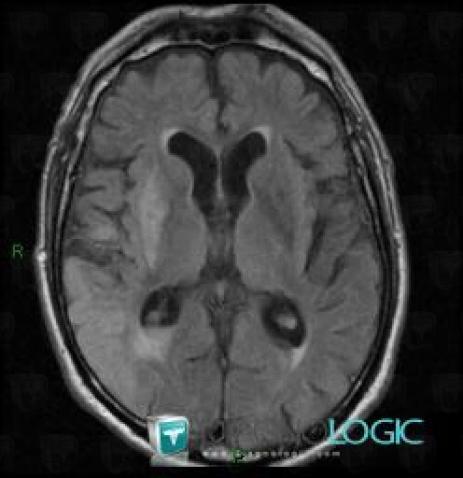 Cerebral infarction, Cerebral hemispheres, Basal ganglia and capsule, MRI