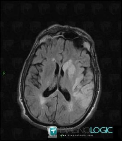 Cerebral infarction, Cerebral hemispheres, Basal ganglia and capsule, MRI