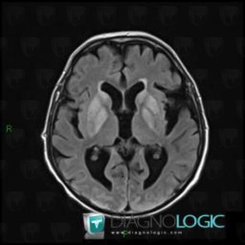 Cerebral infarction, Cerebral hemispheres, Basal ganglia and capsule, MRI