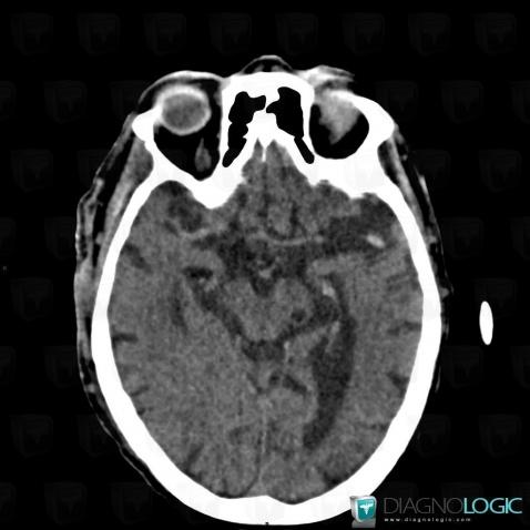 Cerebral infarction, Cerebral hemispheres, CT