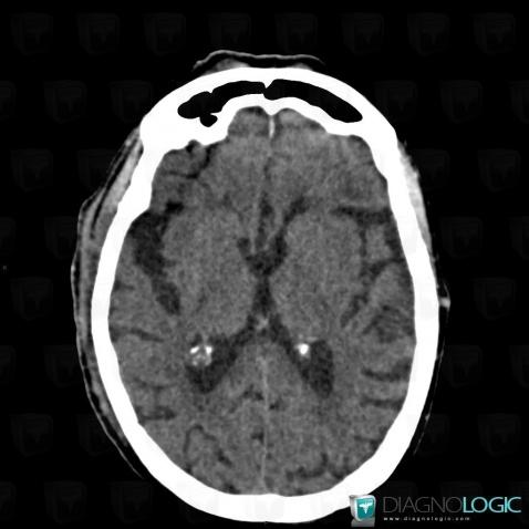 Cerebral infarction, Cerebral hemispheres, CT