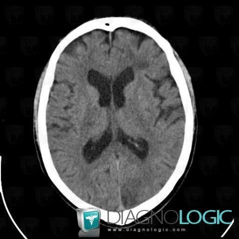 Cerebral infarction, Cerebral hemispheres, CT