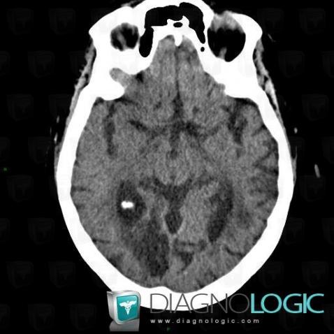 Cerebral infarction, Cerebral hemispheres, CT