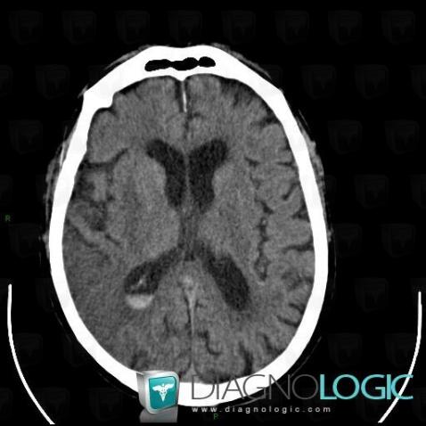 Cerebral infarction, Cerebral hemispheres, CT