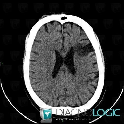 Cerebral infarction, Cerebral hemispheres, CT