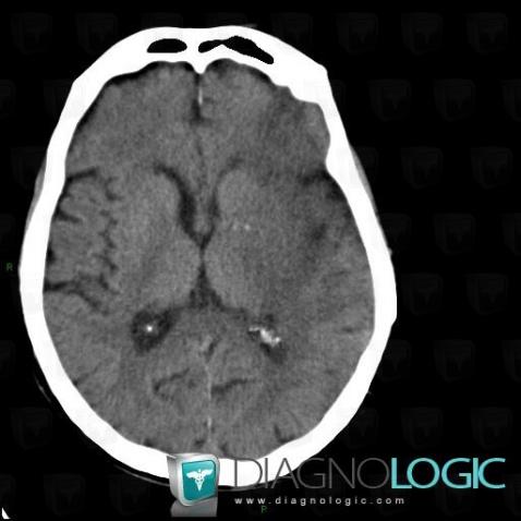 Cerebral infarction, Cerebral hemispheres, CT