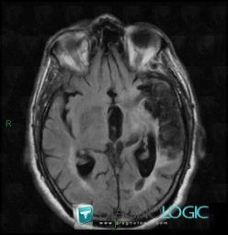 Cerebral infarction, Cerebral hemispheres, MRI