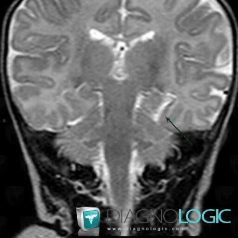 Cerebral infarction, Cerebral hemispheres, MRI