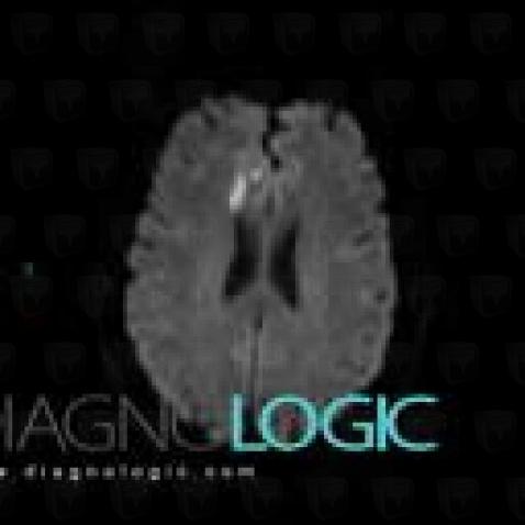 Radiology case : Cerebral infarction (CT ,MRI) - Diagnologic