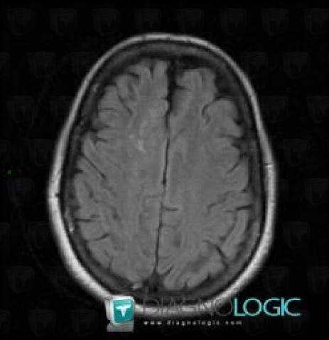 Cerebral infarction, Cerebral hemispheres, MRI