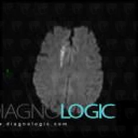 Cerebral infarction, Cerebral hemispheres, MRI