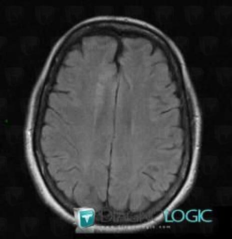 Cerebral infarction, Cerebral hemispheres, MRI