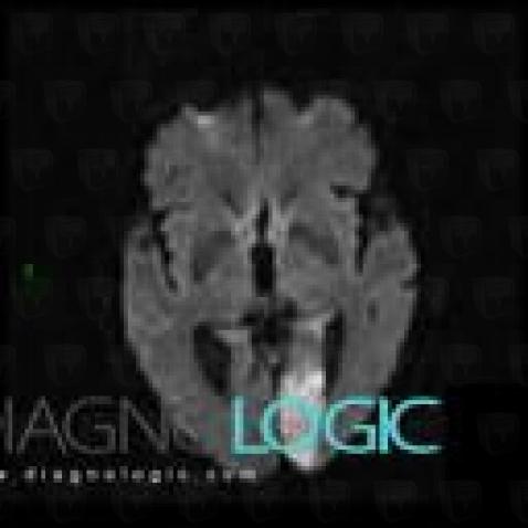 Cerebral infarction, Cerebral hemispheres, MRI