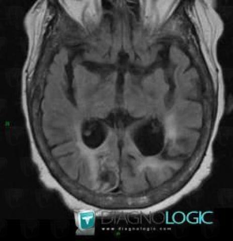 Cerebral infarction, Cerebral hemispheres, MRI