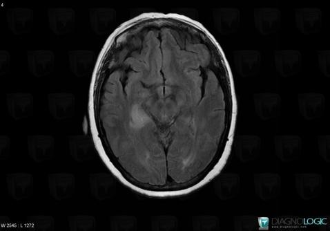 Cerebral infarction, Cerebral hemispheres, MRI