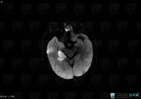 Cerebral infarction, Cerebral hemispheres, MRI