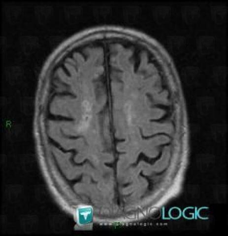 Cerebral infarction, Cerebral hemispheres, MRI