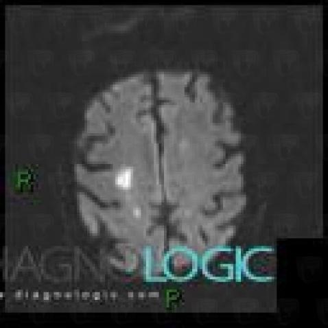 Cerebral infarction, Cerebral hemispheres, MRI