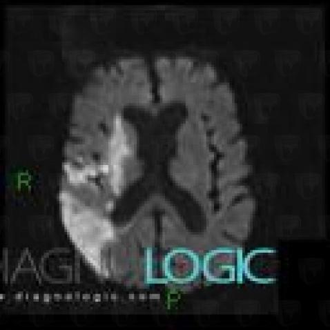 Cerebral infarction, Cerebral hemispheres, MRI