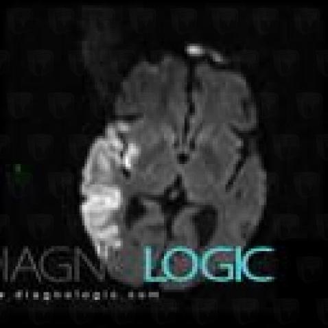 Radiology case : Cerebral infarction (CT ,MRI) - Diagnologic