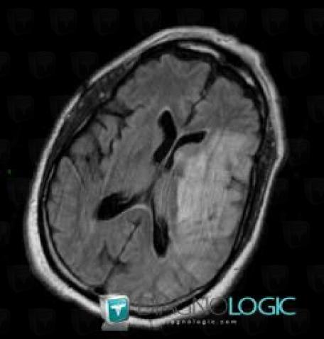 Cerebral infarction, Cerebral hemispheres, MRI