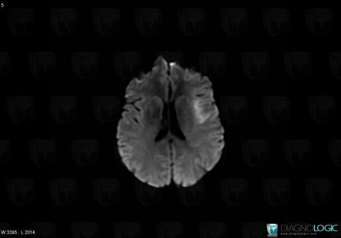 Cerebral infarction, Cerebral hemispheres, MRI