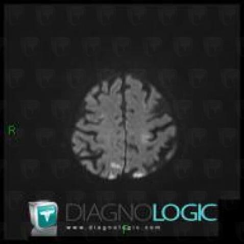 Cerebral infarction, Cerebral hemispheres, MRI