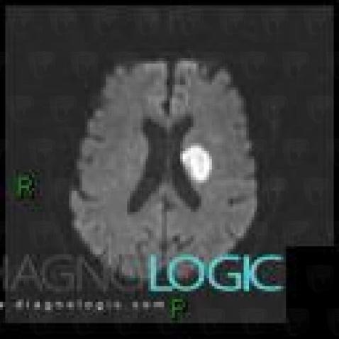 Cerebral infarction, Cerebral hemispheres, MRI