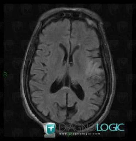 Cerebral infarction, Cerebral hemispheres, MRI