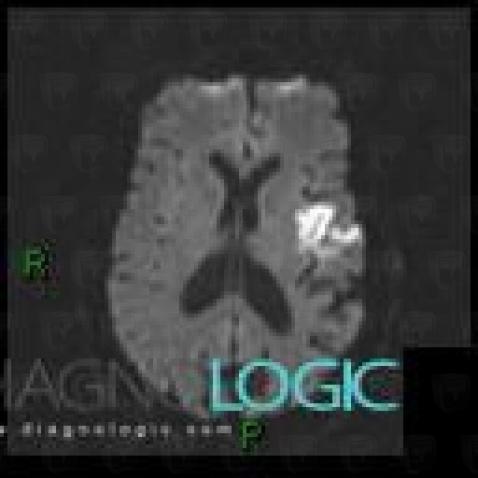 Radiology case : Cerebral infarction (MRI) - Diagnologic