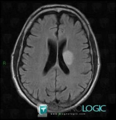 Cerebral infarction, Cerebral hemispheres, Ventricles / Periventricular region, MRI