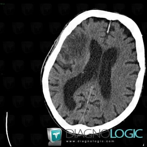 Cerebral infarction, Cortico subcortical region, Cerebral hemispheres, CT