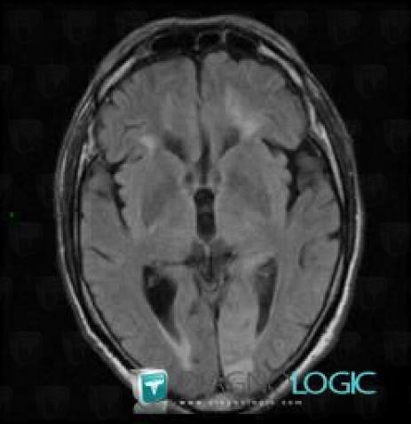 Cerebral infarction, Cortico subcortical region, Cerebral hemispheres, MRI
