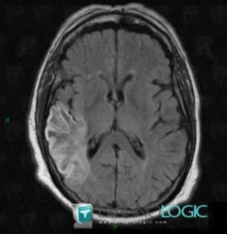 Cerebral infarction, Cortico subcortical region, Cerebral hemispheres, MRI