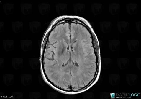 Cerebral infarction, Cortico subcortical region, MRI