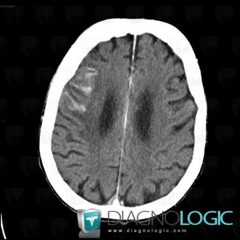 Cerebral infarction, Supratentorial peri cerebral spaces, Cortico subcortical region, CT