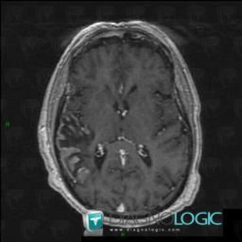 Cerebral infarction, Supratentorial peri cerebral spaces, Cortico subcortical region, MRI