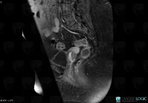 Cervical carcinoma, Uterus, MRI