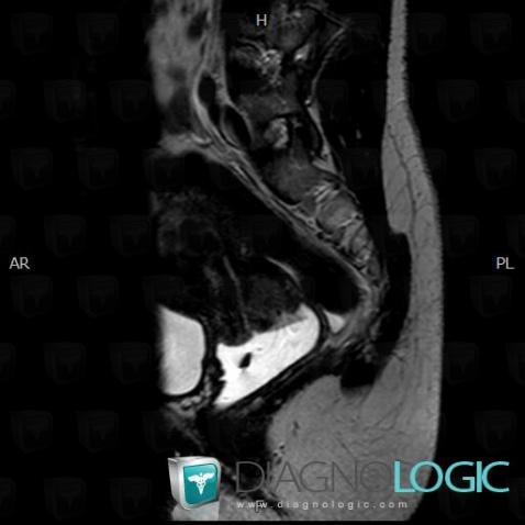 Cervical carcinoma, Uterus, MRI