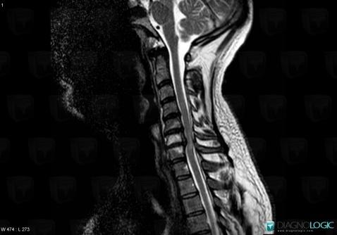 Cervical spondylotic myelopathy, Vertebral body / Disk, Spinal canal / Cord, MRI