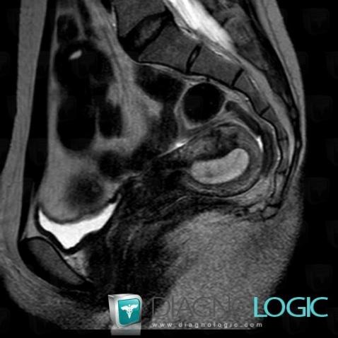 Cervical stenosis, Uterus, MRI