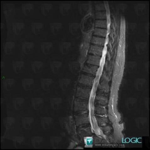 Charcot-Marie-tooth disease, Spinal canal / Cord, MRI