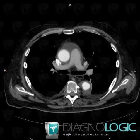 Chester-Erdheim disease, Aorta, CT