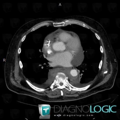 Chester-Erdheim disease, Cardiac cavities / Pericardium, CT