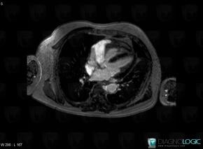 Chester-Erdheim disease, Cardiac cavities / Pericardium, MRI