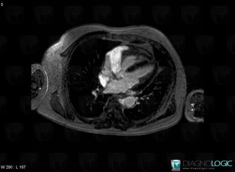 Chester-Erdheim disease, Cardiac cavities / Pericardium, MRI
