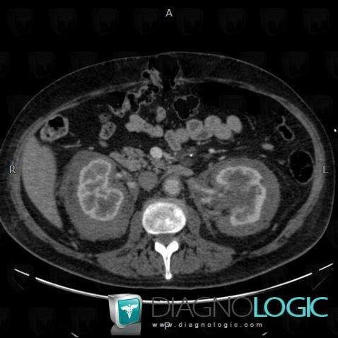 Chester-Erdheim disease, Kidney, Retroperitoneum, CT