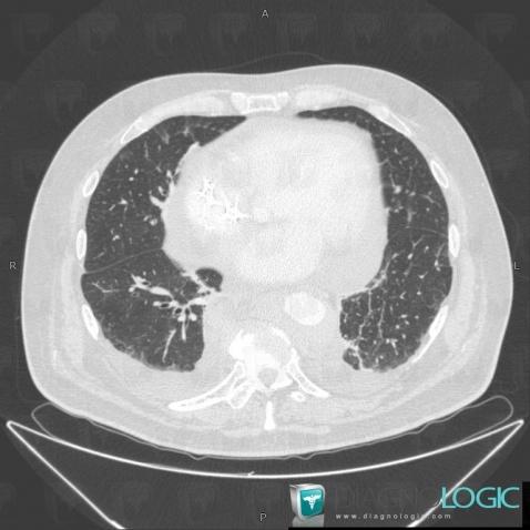 Chester-Erdheim disease, Pulmonary parenchyma, CT